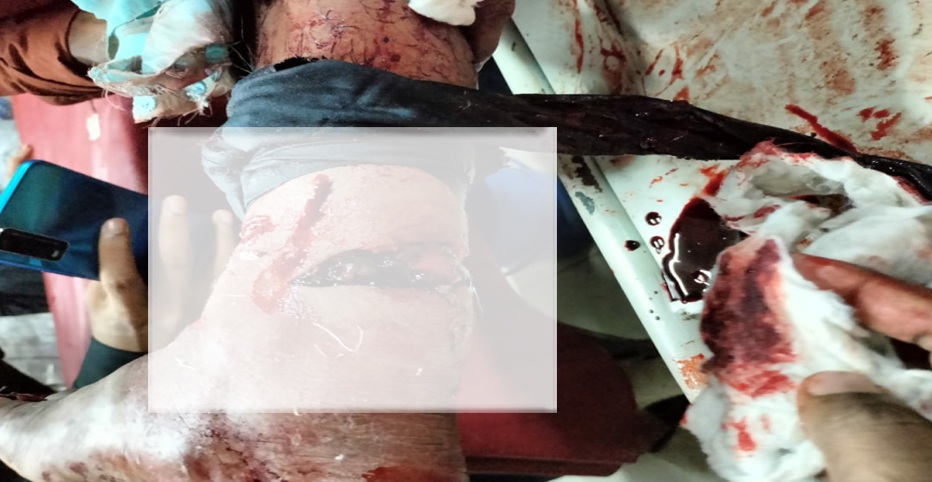 স্বেচ্ছাসেবক লীগ নেতার পায়ের রগ কাটার অভিযোগ যুবলীগ কর্মীর বিরুদ্ধে